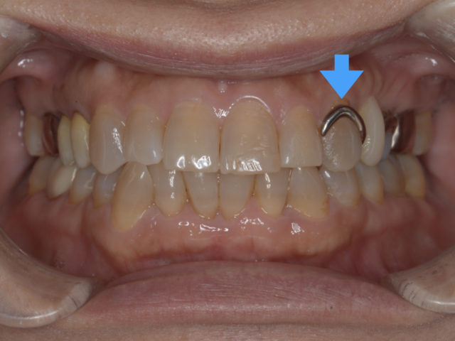 部分入れ歯の金属 気になりませんか？？｜西宮歯医者 矯正歯科・こども歯科H&L｜西宮市の西宮北口駅の歯医者