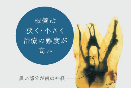 根管は狭く・小さく治療の難度が高い